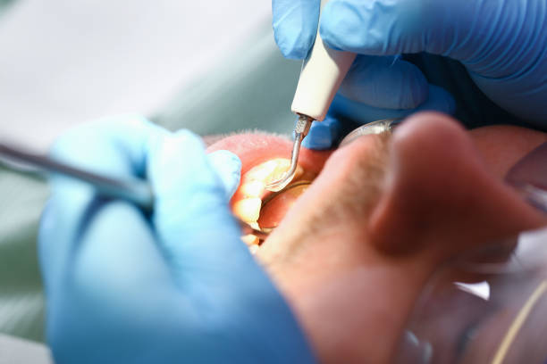 Best Dentist for Tooth Abscess  in Clay, AL